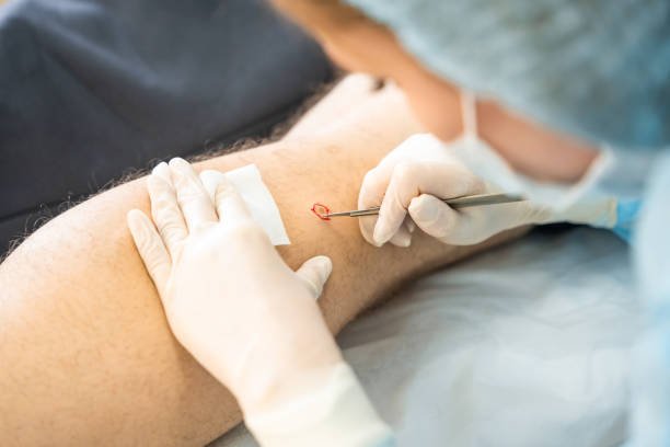 A doctor performing a minor surgical procedure on the skin