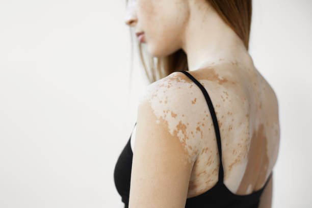 Vitiligo Surgery