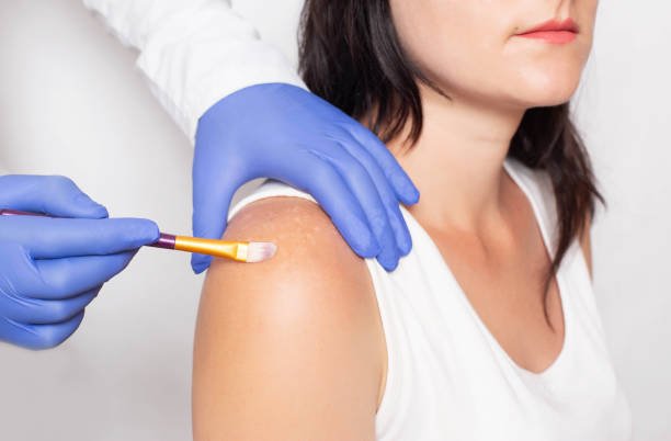 A doctor performing skin grafting for vitiligo
